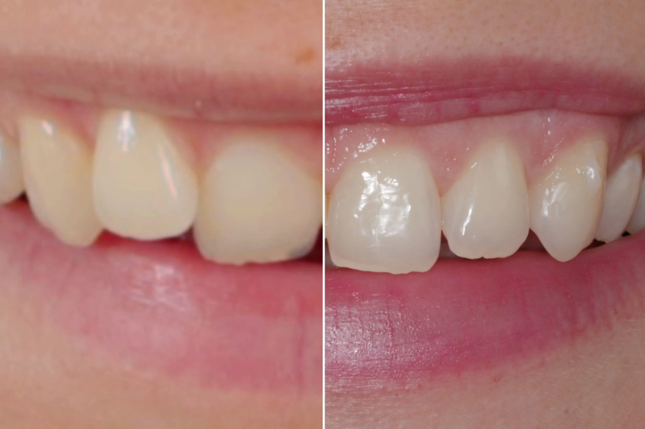 Aligner 1