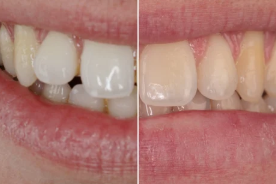 Aligner 2