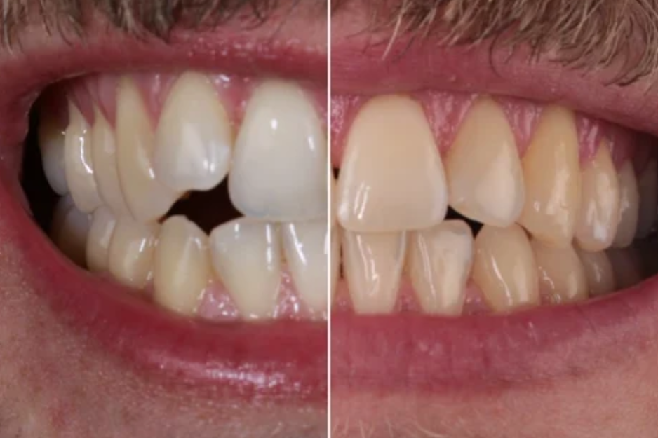 Aligner 3